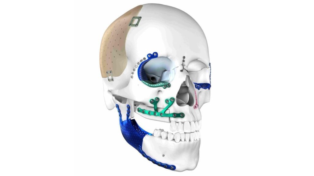 Global Craniomaxillofacial Implants Market Size, Segments, Growth, Trends & Forecast | 2024 – 2032