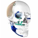 Global Craniomaxillofacial Implants Market Size, Segments, Growth, Trends & Forecast | 2024 – 2032